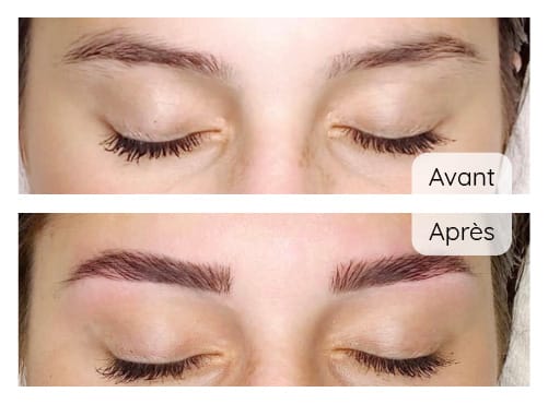 Brow Lift (avant/après)