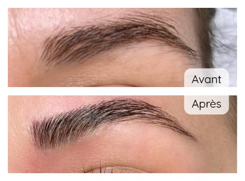 Brow Lift (avant/après)